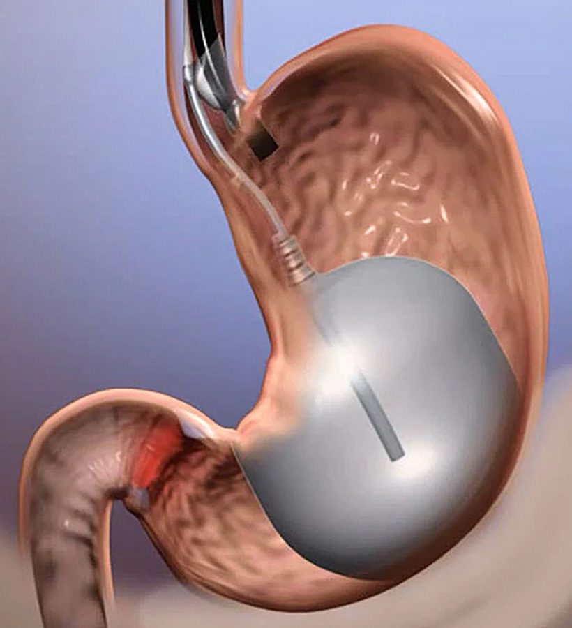 Intragastric Balloon Medical Device